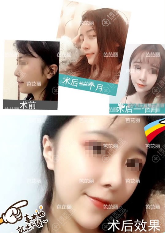 南宁芭芘丽肋软骨隆鼻案例 南宁芭芘丽肋软骨隆鼻案例