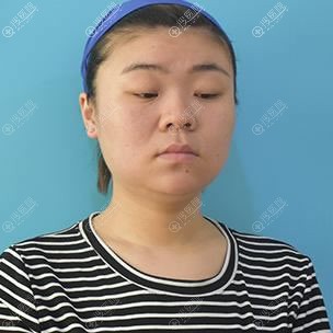 真让人意外,我在湘潭雅美整形医院做完膨体隆鼻居然没影响上班
