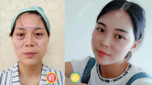 我的主刀医生武汉华美医院马行说脂肪填充后这些东西都不能吃