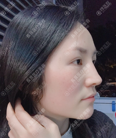 <!--<i data=20240710 data-id=16214></i>--><!--<i data=20240710 data-id=16815></i>-->线雕案例一个月效果 <!--<i data=20240710 data-id=16214></i>--><!--<i data=20240710 data-id=16815></i>-->线雕案例一个月效果