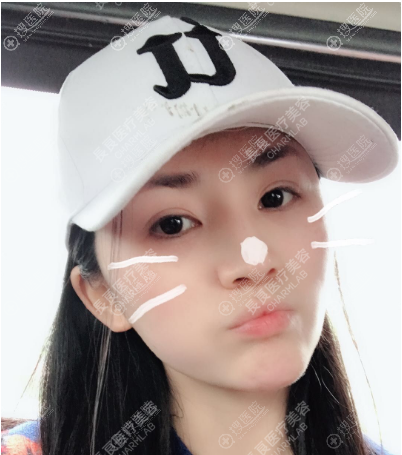 <!--<i data=20240710 data-id=16214></i>-->线雕案例两个月拥有少女脸 <!--<i data=20240710 data-id=16214></i>-->线雕案例两个月拥有少女脸
