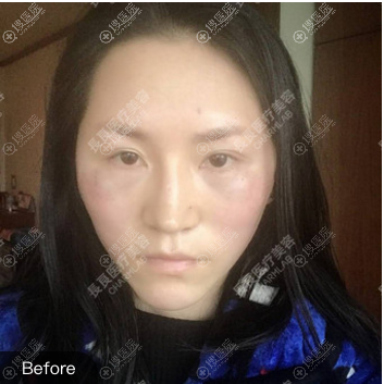 线雕提升术前照片 线雕提升术前照片
