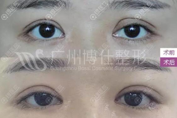广州博仕整形张建军双眼皮失败修复真人案例 广州博仕整形张建军双眼皮失败修复真人案例