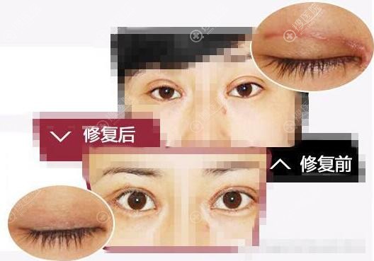 广州壹加壹项美连双眼皮失败修复效果对比图 广州壹加壹项美连双眼皮失败修复效果对比图