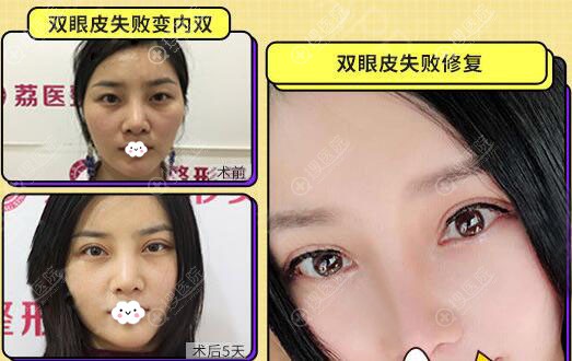 广州荔医李增产眼部修复案例对比图 广州荔医李增产眼部修复案例对比图