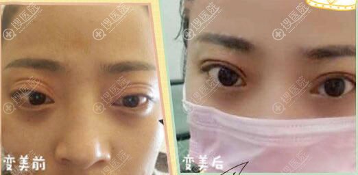 广州荔医医疗美容曾德浩双眼皮失败修复案例 广州荔医医疗美容曾德浩双眼皮失败修复案例
