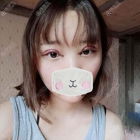 张慧敏切开双眼皮术后即刻效果 张慧敏切开双眼皮术后即刻效果