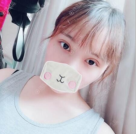 张慧敏双眼皮开眼角拆线后效果 张慧敏双眼皮开眼角拆线后效果