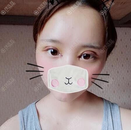 双眼皮开眼角术后3天 双眼皮开眼角术后3天