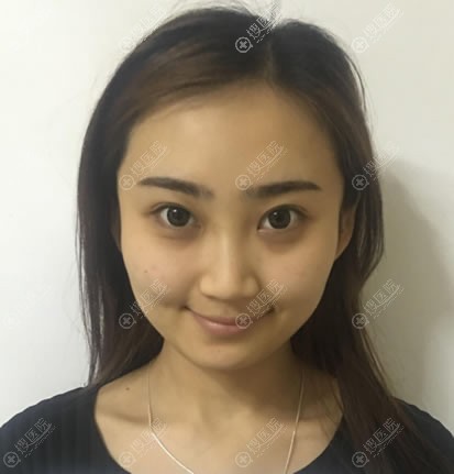 初次整形我交给长沙梵童彭见生做了大腿抽脂和自体脂肪面部填充