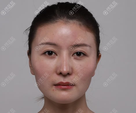 放弃远赴韩国整形,选择重庆华美韩方院长陈熏做颧骨颧弓下颌角