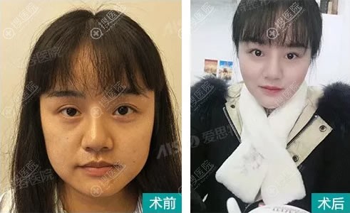 <!--<i data=20240710 data-id=14448></i>-->袁伟下颌角改脸型案例 <!--<i data=20240710 data-id=14448></i>-->袁伟下颌角改脸型案例