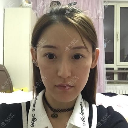 北京本土人告诉你北京艺星郑仕平做大腿抽脂和自体脂肪填充怎样