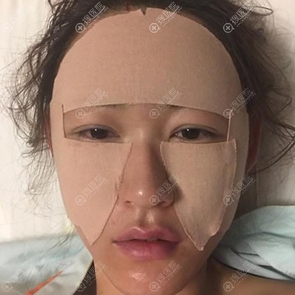 刚做完自体脂肪面部填充照片 刚做完自体脂肪面部填充照片