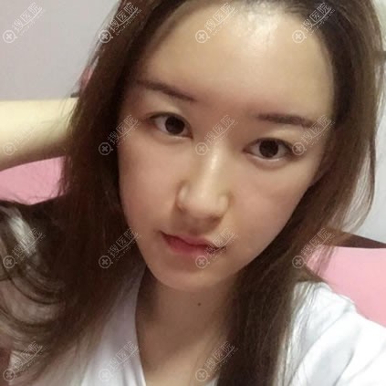在北京艺星做自体脂肪填充15天后 在北京艺星做自体脂肪填充15天后