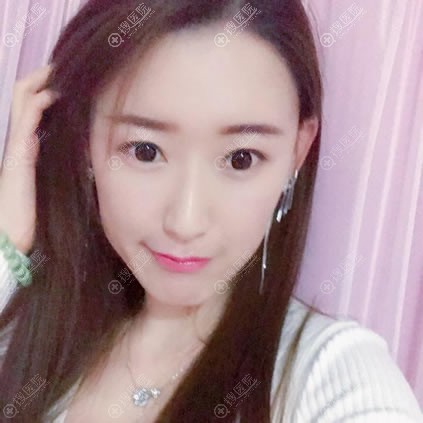 北京艺星郑仕平脂肪填充案例40天效果 北京艺星郑仕平脂肪填充案例40天效果