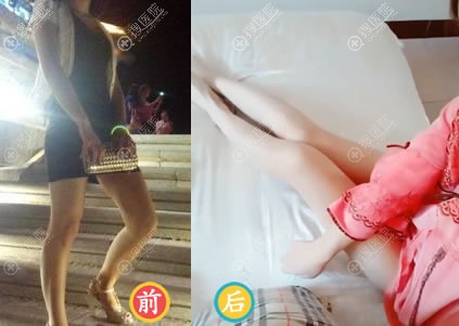 北京艺星郑仕平大腿吸脂案例 北京艺星郑仕平大腿吸脂案例