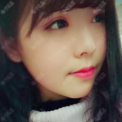 找<!--<i data=20240710 data-id=11985></i>-->张勇做双眼皮10天后 找<!--<i data=20240710 data-id=11985></i>-->张勇做双眼皮10天后