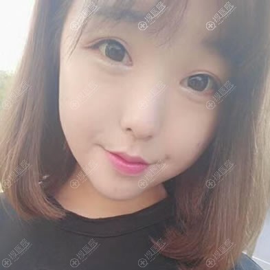 <!--<i data=20240710 data-id=11985></i>-->双眼皮开眼角案例3月效果 <!--<i data=20240710 data-id=11985></i>-->双眼皮开眼角案例3月效果