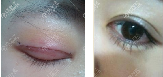 海南星之美韩式双眼皮术后即刻与恢复案例效果图 海南星之美韩式双眼皮术后即刻与恢复案例效果图