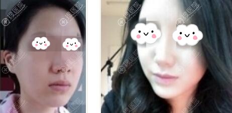 海南星之美鼻综合隆鼻真人案例 海南星之美鼻综合隆鼻真人案例