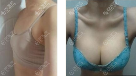 海南星之美假体隆胸真人案例 海南星之美假体隆胸真人案例