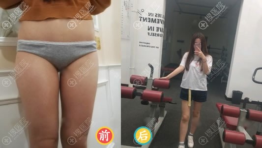 <!--<i data=20240710 data-id=16571></i>-->吸脂瘦大腿案例 <!--<i data=20240710 data-id=16571></i>-->吸脂瘦大腿案例