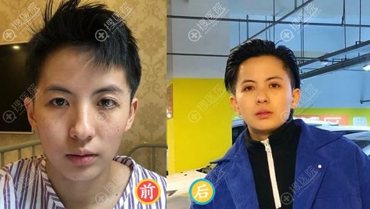<!--<i data=20240710 data-id=16571></i>-->做双眼皮和开眼角综合案例 <!--<i data=20240710 data-id=16571></i>-->做双眼皮和开眼角综合案例