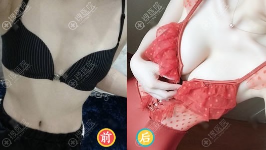 <!--<i data=20240710 data-id=13404></i>-->医院徐义杰假体隆胸案例 <!--<i data=20240710 data-id=13404></i>-->医院徐义杰假体隆胸案例
