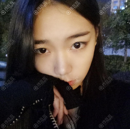 西安画美双眼皮案例术前照片 西安画美双眼皮案例术前照片