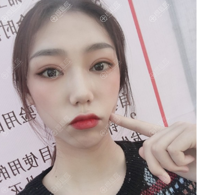西安画美全切双眼皮术后10天图片 西安画美全切双眼皮术后10天图片