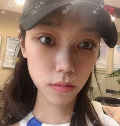 全切双眼皮+开眼角术后7天自拍 全切双眼皮+开眼角术后7天自拍
