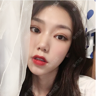 西安画美罗曼做的全切双眼皮案例 西安画美罗曼做的全切双眼皮案例