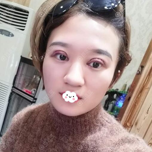 <!--<i data=20240710 data-id=12188></i>-->王用洪韩式切开双眼皮术后第1天效果 <!--<i data=20240710 data-id=12188></i>-->王用洪韩式切开双眼皮术后第1天效果