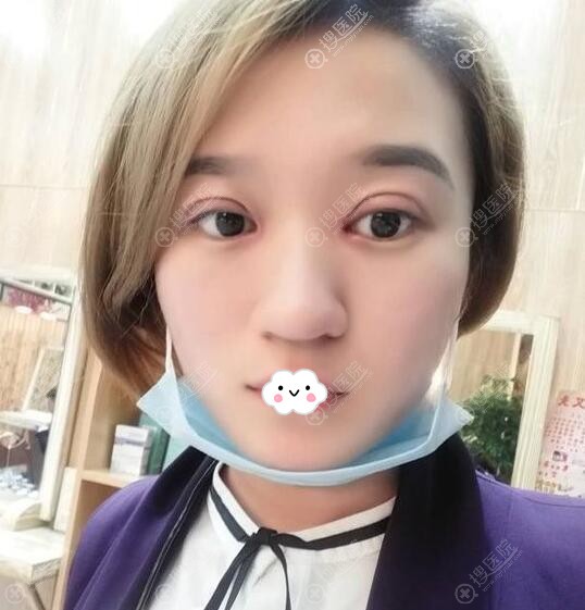 宁波割双眼皮哪家医院好?<!--<i data=20240710 data-id=12188></i>-->王用洪案例 宁波割双眼皮哪家医院好?<!--<i data=20240710 data-id=12188></i>-->王用洪案例