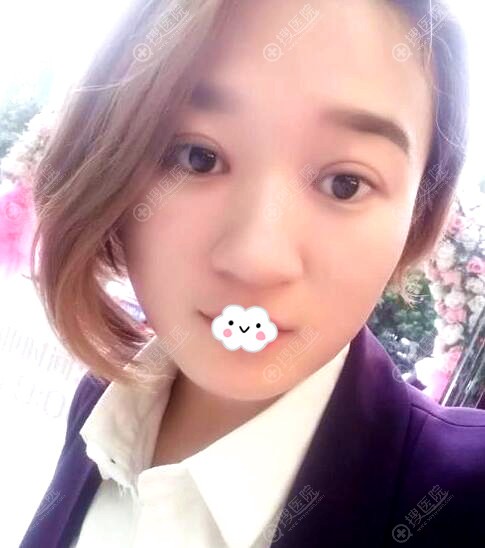 <!--<i data=20240710 data-id=12188></i>-->割双眼皮效果怎么样?王用洪案例术后图 <!--<i data=20240710 data-id=12188></i>-->割双眼皮效果怎么样?王用洪案例术后图