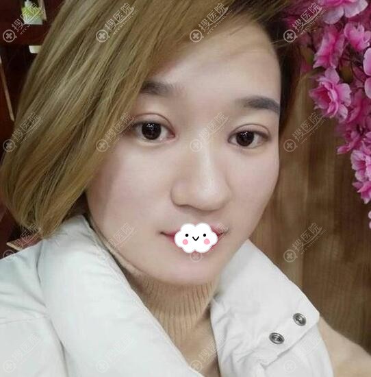 <!--<i data=20240710 data-id=12188></i>-->双眼皮+开眼角案例恢复效果图 <!--<i data=20240710 data-id=12188></i>-->双眼皮+开眼角案例恢复效果图