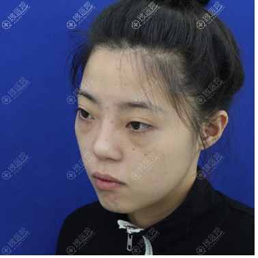 听说吉林长春国健医美是正规医院后找吕启凤做了双眼皮和隆鼻