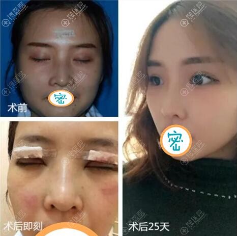 <!--<i data=20240710 data-id=12005></i>-->双眼皮开眼角术后效果展示 <!--<i data=20240710 data-id=12005></i>-->双眼皮开眼角术后效果展示