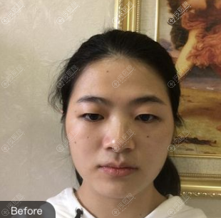 福州台江双眼皮案例术前照 福州台江双眼皮案例术前照