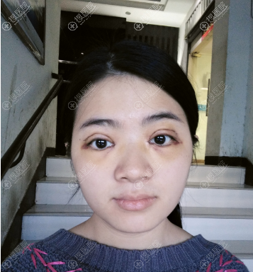 福州台江钟波双眼皮案例7天效果 福州台江钟波双眼皮案例7天效果