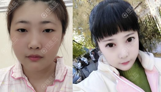 北京华韩李鹏超为学生做双眼皮开眼角案例 北京华韩李鹏超为学生做双眼皮开眼角案例