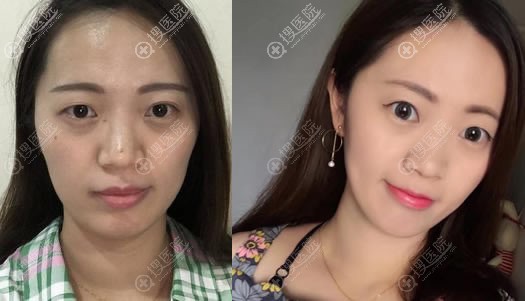 北京华韩王新玉为教师做热玛吉抗衰老案例 北京华韩王新玉为教师做热玛吉抗衰老案例