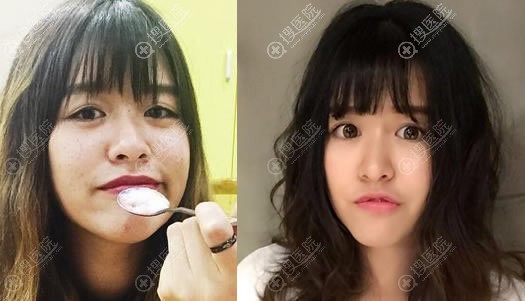 北京华韩张冬梅为学生做激光祛斑美肤案例 北京华韩张冬梅为学生做激光祛斑美肤案例