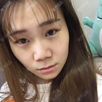 当你还在犹豫时我已经选择北京长虹于志宏做鼻综合隆鼻完成蜕变