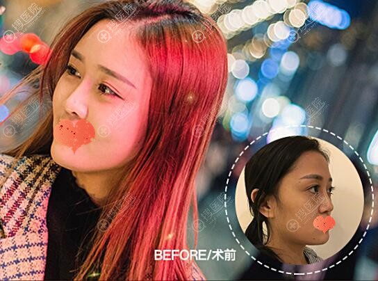 刘中国自体脂肪面部填充对比图 刘中国自体脂肪面部填充对比图