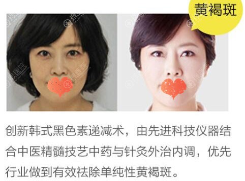 <!--<i data=20240710 data-id=13409></i>-->何芳黄褐斑效果图 <!--<i data=20240710 data-id=13409></i>-->何芳黄褐斑效果图