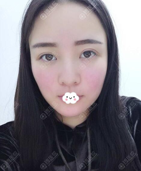 成都成美美容整形医院王立鹏双眼皮术后7天效果 成都成美美容整形医院王立鹏双眼皮术后7天效果