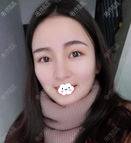 成都美容整形医院双眼皮+开眼角案例效果 成都美容整形医院双眼皮+开眼角案例效果