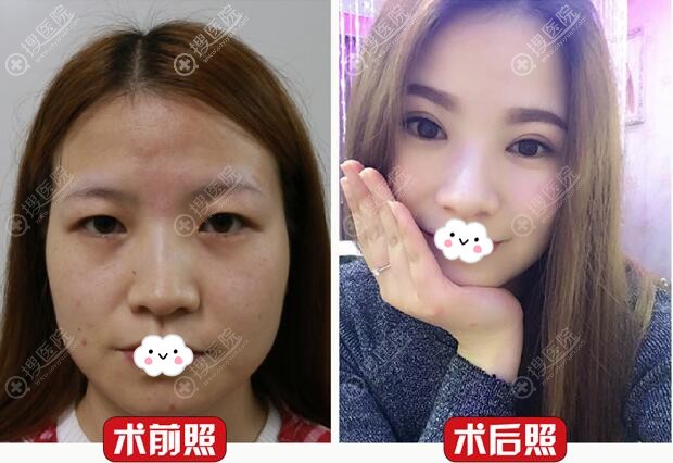 成都成美美容整形医院<!--<i data=20240710 data-id=16577></i>-->双眼皮案例效果对比图 成都成美美容整形医院<!--<i data=20240710 data-id=16577></i>-->双眼皮案例效果对比图